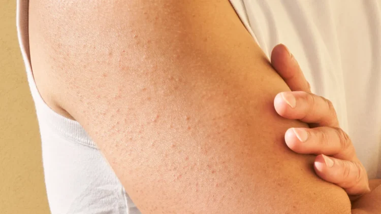 Ilustrasi keratosis pilaris yang muncul pada lengan atas seseorang. (girlsbeyond.com)