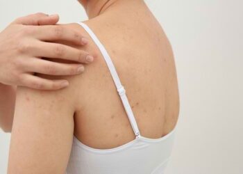 Punya Masalah dengan Jerawat di Punggung? Simak Ini (ULTIMAGZ)