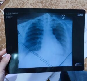 Hasil rontgen organ paru-paru Detty ketika di periksa di Rumah Sakit Koja, Cillincing, pada Jumat (04/11/2022). (Foto: Grace Vilia).